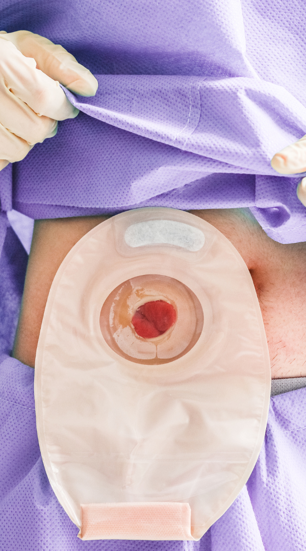 Stoma Care Training A medical ostomy bag attached to the abdomen, showing a small red stoma.