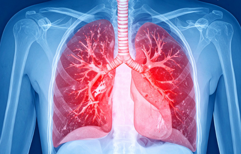 Illustration of human lungs with bronchial tree, highlighted in red.
