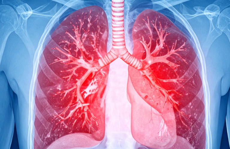 Illustration of human lungs with highlighted bronchial structures.